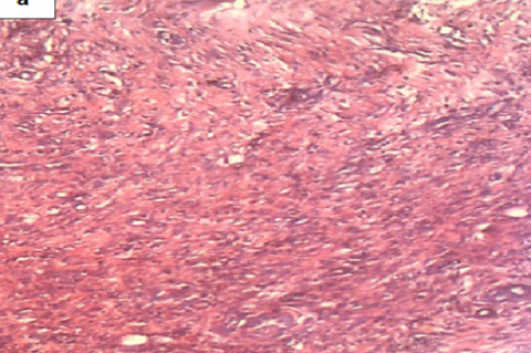 Histology of wound on day 10 in excision wound rats