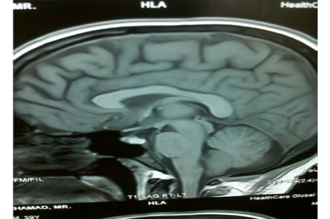 MRI scan of the brain MRI scan of the brain showed bleed in the neurohypophysis extending to the stalk