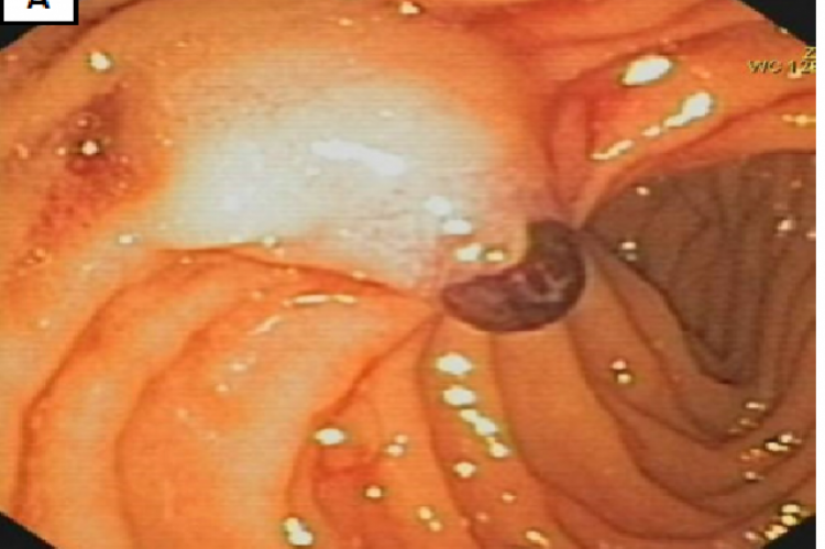 Endoscopic images of the duodenal ampulla showing a large blood clot exiting the orifice confirming the diagnosis of hemobilia